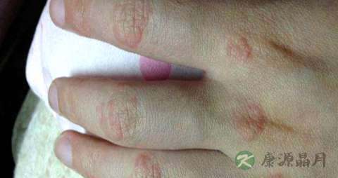 红斑狼疮吃什么药