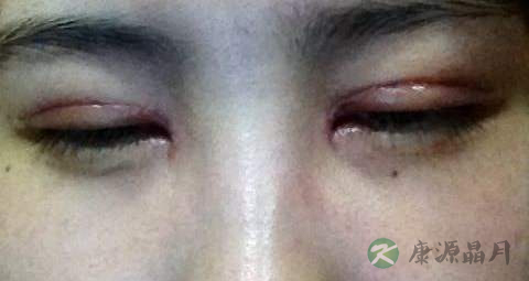 疤痕增生吃什么药