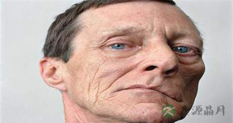 面神经麻痹吃什么药