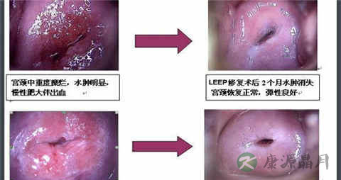 宫颈肥大吃什么药