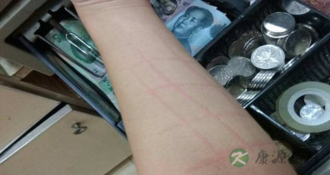 急性荨麻疹不能吃什么，急性荨麻疹的注意事
