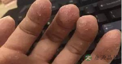 手足癣不能吃什么，手足癣的注意事项
