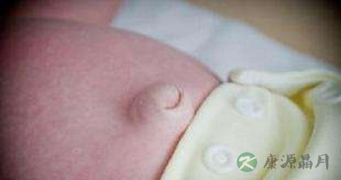 婴儿脐疝不能吃什么，婴儿脐疝的注意事项