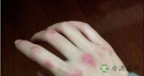 冻疮不能吃什么，冻疮的注意事项