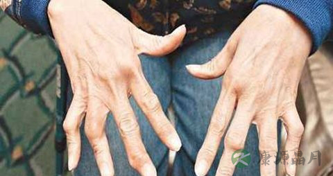风湿性关节炎不能吃什么，风湿性关节炎的注意事项