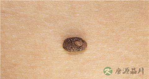 黑色素瘤不能吃什么，黑色素瘤的注意事项