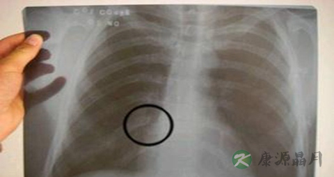 结核性胸膜炎不能吃什么，结核性胸膜炎的注意事项