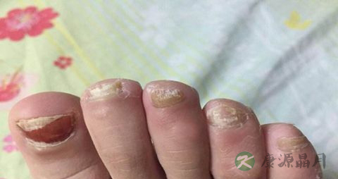 甲癣不能吃什么，甲癣的注意事项
