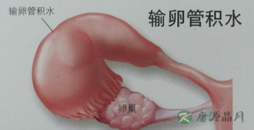 输卵管积水造影表现