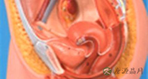 霉菌性盆腔炎是怎么回事