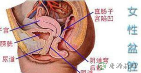 盆腔积液多如何排除