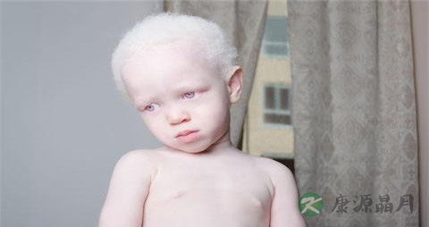 白化病人能活多少年