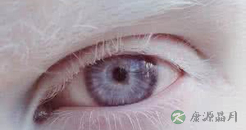 眼部白化病是遗传吗
