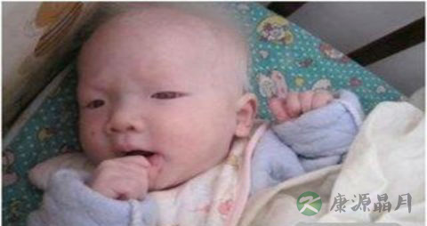 白化病婴儿爱流泪吗