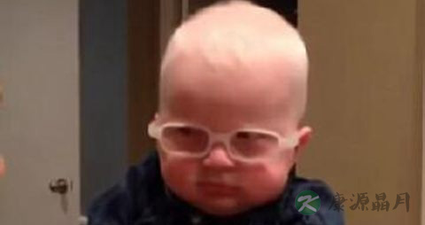 白化病婴儿有视力吗