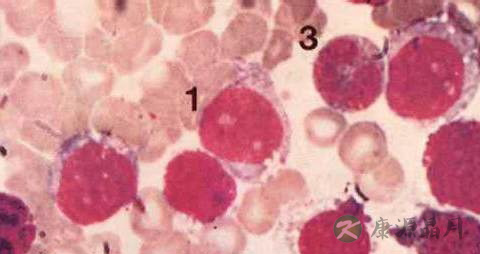 慢性粒细胞白血病怀孕了怎么办