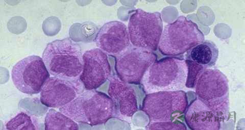 慢性粒细胞白血病怀孕了怎么办