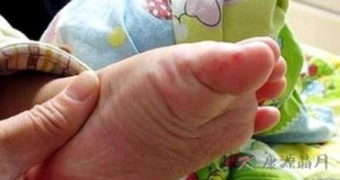 手足口病病后怎么护理