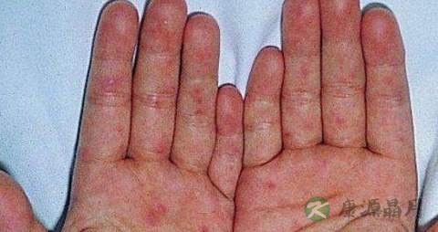 手足口病病后怎么护理