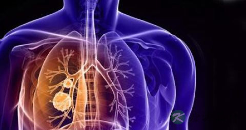 怎样区分肺结核和肺癌