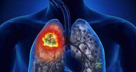 中医治疗肺癌的偏方