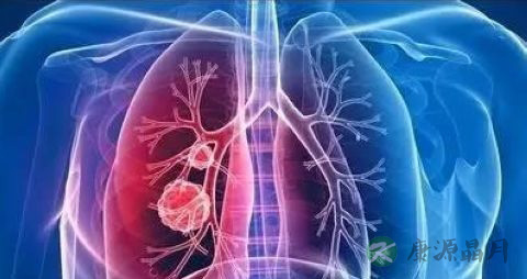 肺癌治愈率高吗