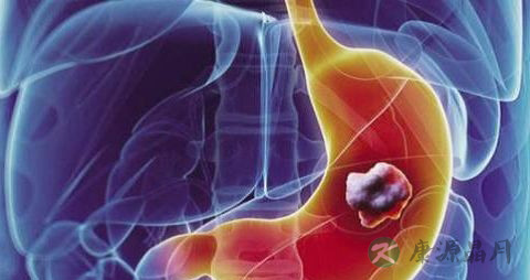 长期口臭是胃癌的前兆
