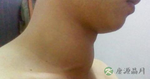 甲状腺肿瘤不开刀可以治好吗