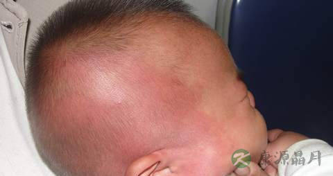 婴儿的头部血管瘤常见分类是什么