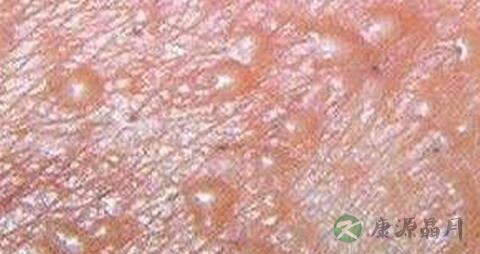 生殖器疱疹的潜伏期是多久
