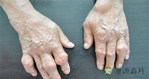 手指类风湿的治疗方法