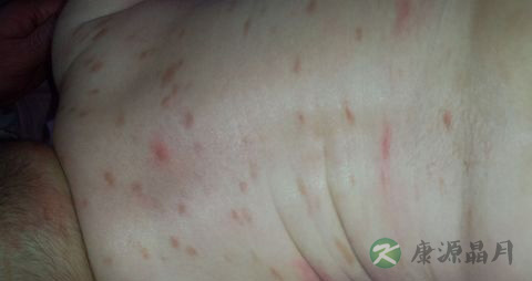 宝宝得了风湿疹怎么办