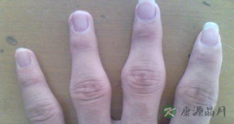 为什么手指节会痛