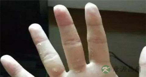 手指关节错位怎么办