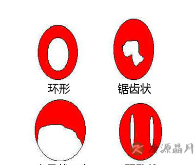 图解处女膜：在哪儿，长啥样？