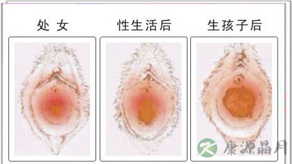 大尺度：直击处女膜各种真实形状