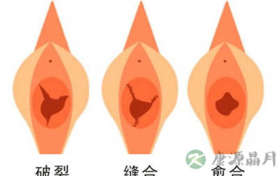 如何轻松鉴别处女膜真假？