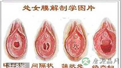 多图实拍:处女膜的位置和形态