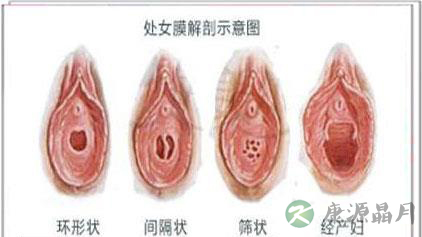 大尺度：直击处女膜各种真实形状