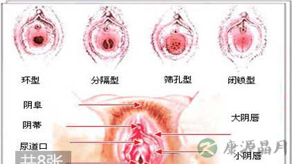 多图实拍:处女膜的位置和形态