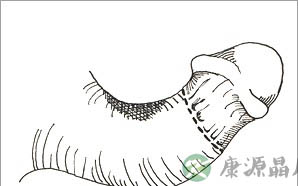 男人“小弟弟”形状大公开