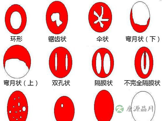 处女膜长什么样_处女膜破了怎么办