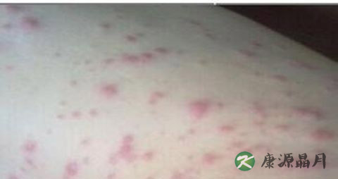秋季预防皮肤过敏怎么做