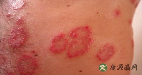 秋季怎么预防皮肤病