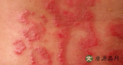 秋季怎么预防皮肤病
