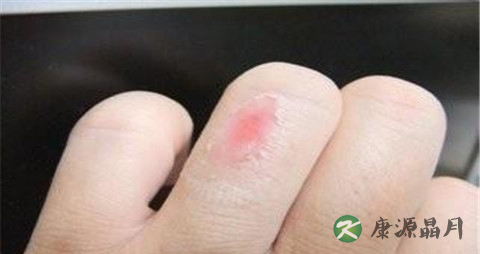 冻疮是怎么回事