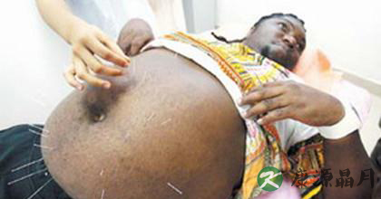 针灸减肥是根据什么原理