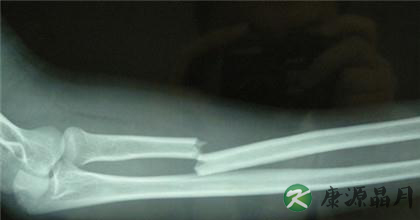 骨折病人的护理方方面面 骨折病人的护理方方面面