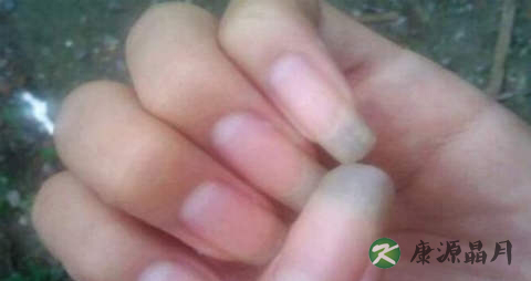 指甲半月痕正常吗