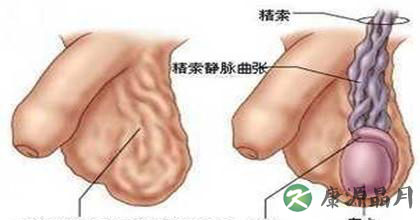 患了精索静脉曲张怎么办